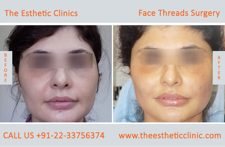 thread facelift, face lifting with threads treatment before after photos in mumbai india (10)